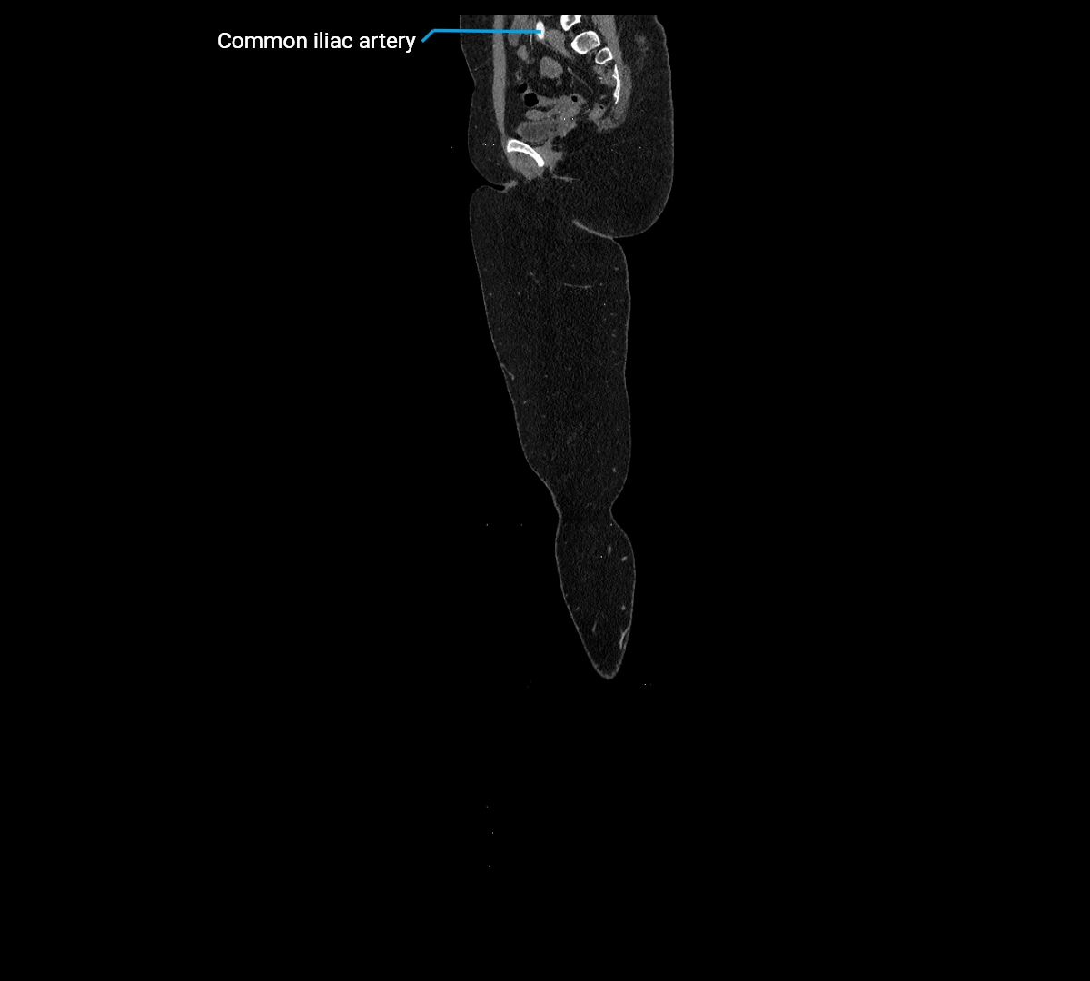 CTA lower limb sagittal cross sectional anatomy labelled image _5 (2).webp
